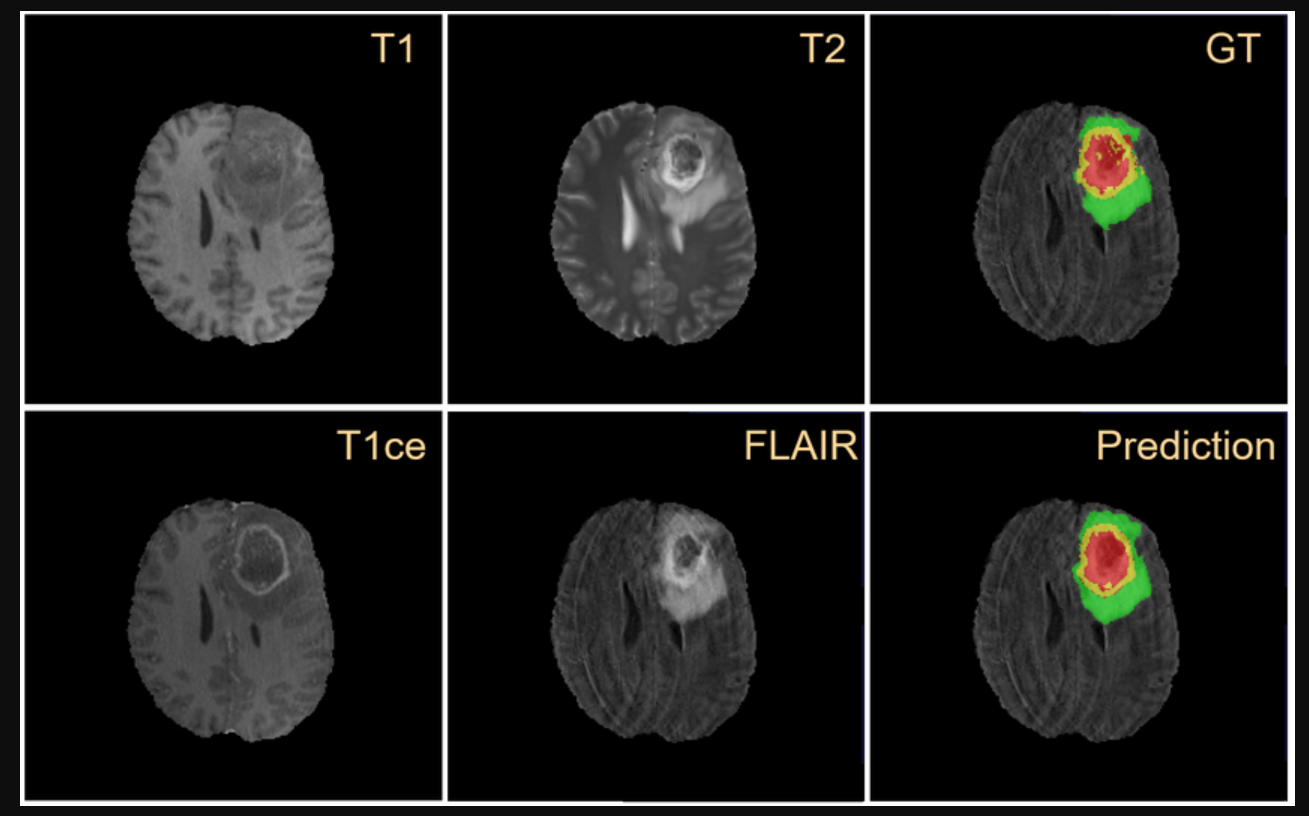 Figure from BRAIN TUMOR SEGMENTATION OF MRI SEQUENCES (T1, T2, T1CE, FLAIR) USING BRATS DATASET